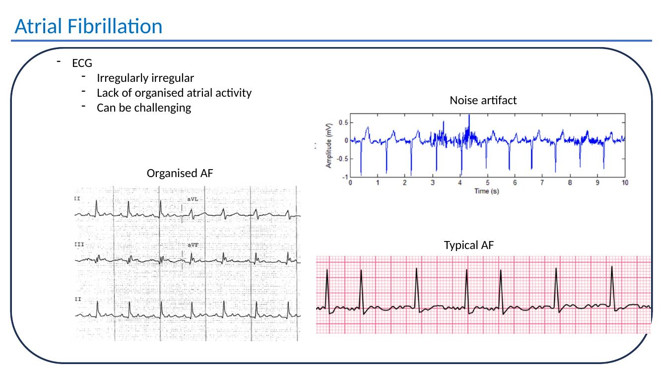 Atrial fibrillation ECG examples