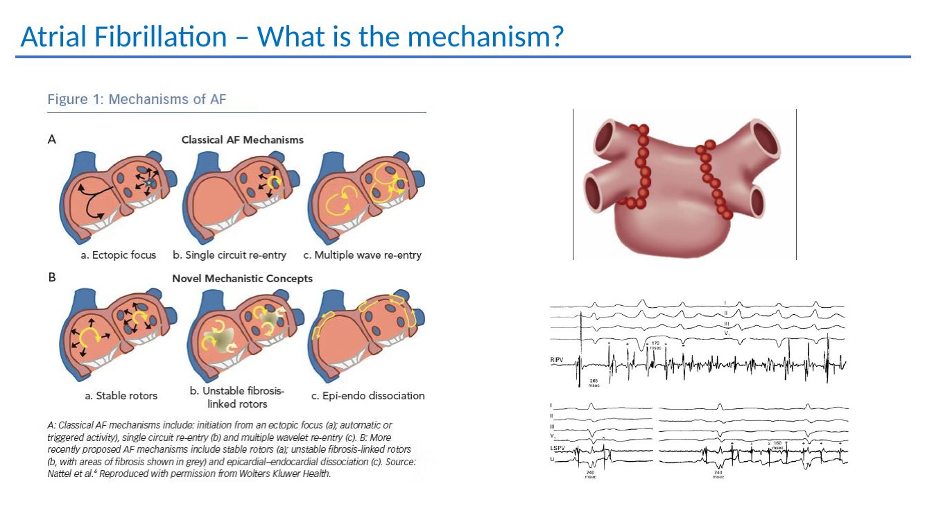Atrial fibrillation mechanism