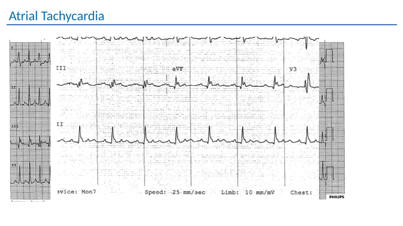 Atrial tachycardia