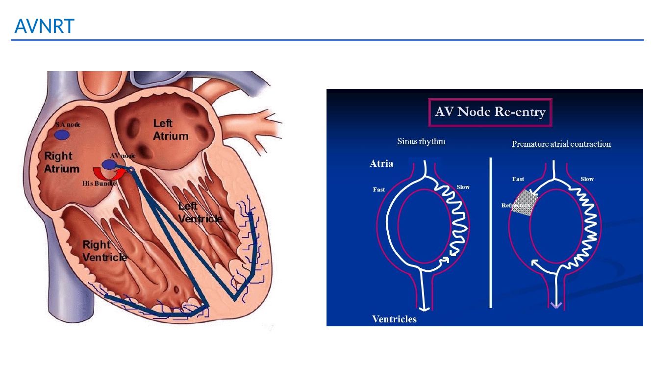 AVNRT teaching slide