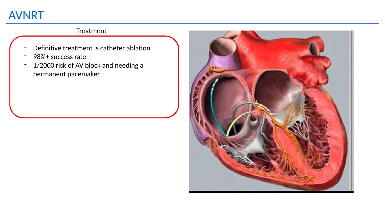 AVNRT treatment slide