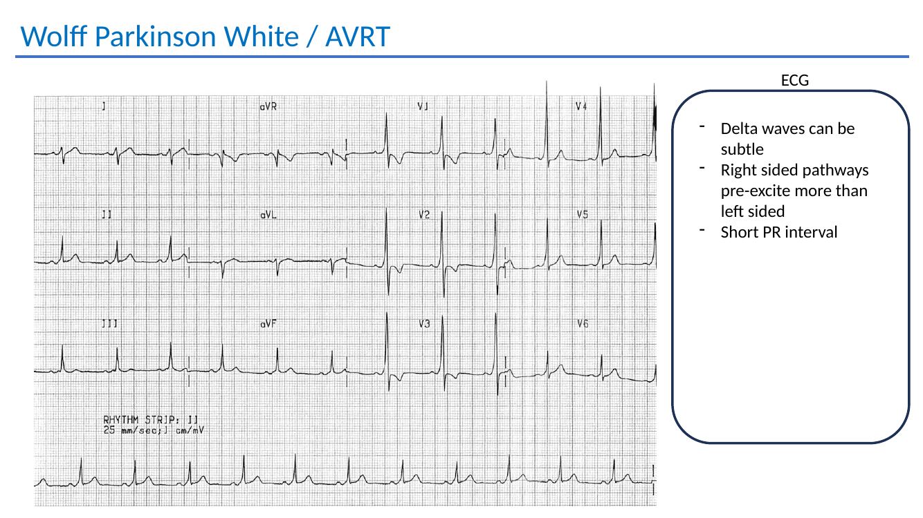 WPW ECG slide