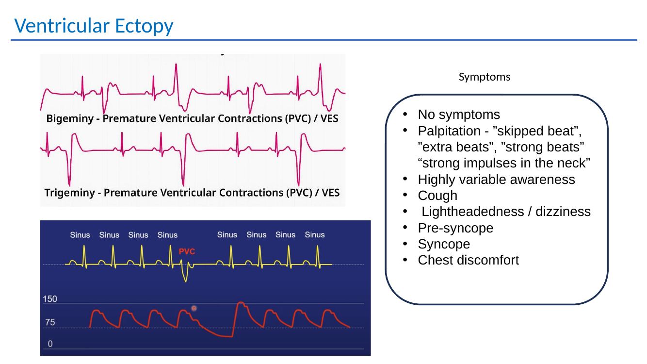 Ventricular ectopy symptoms