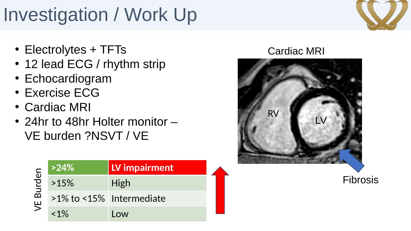 Ventricular ectopy burden and cardiac MRI slide
