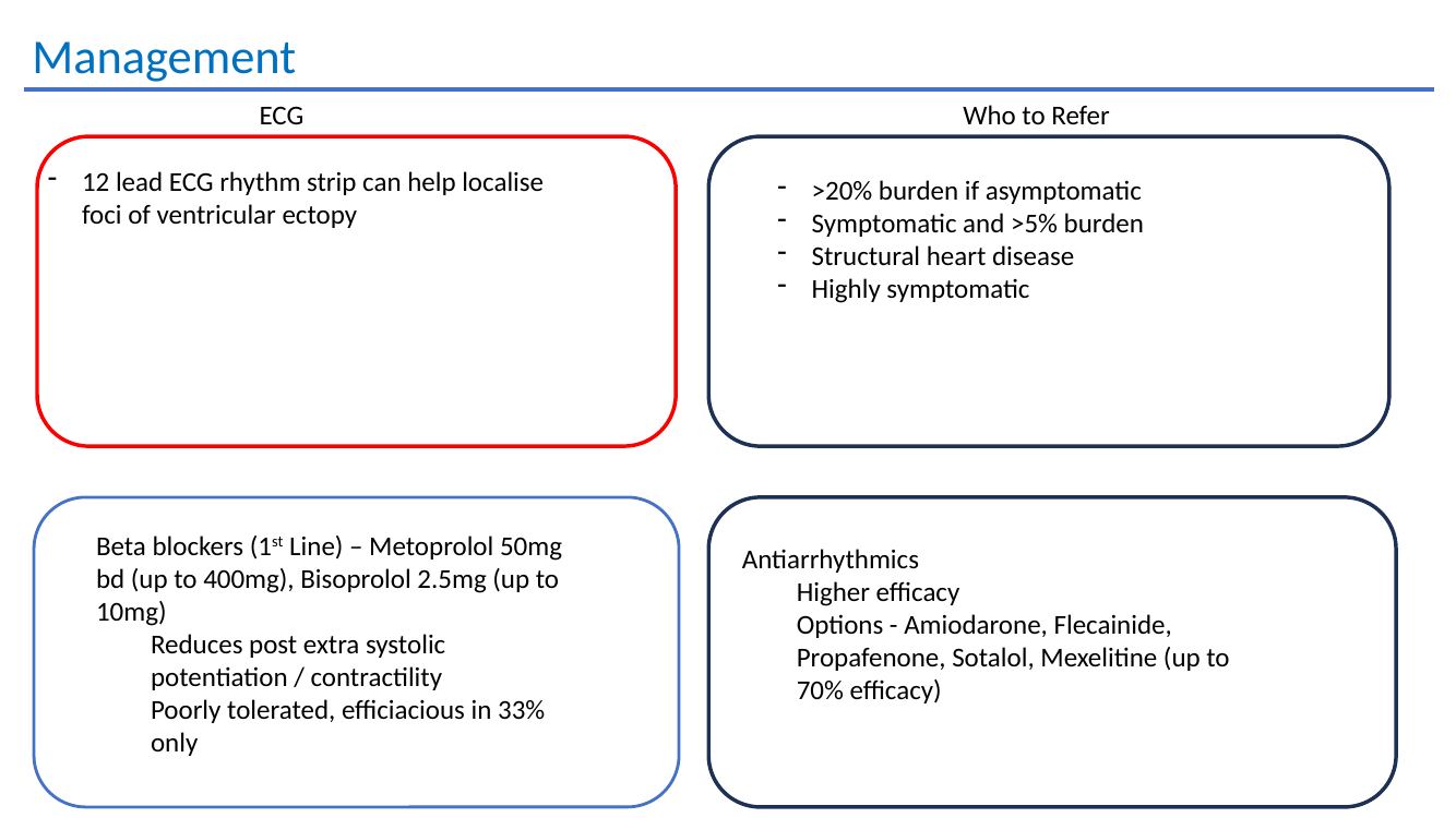 12 lead ECG localisation of ventricular ectopy