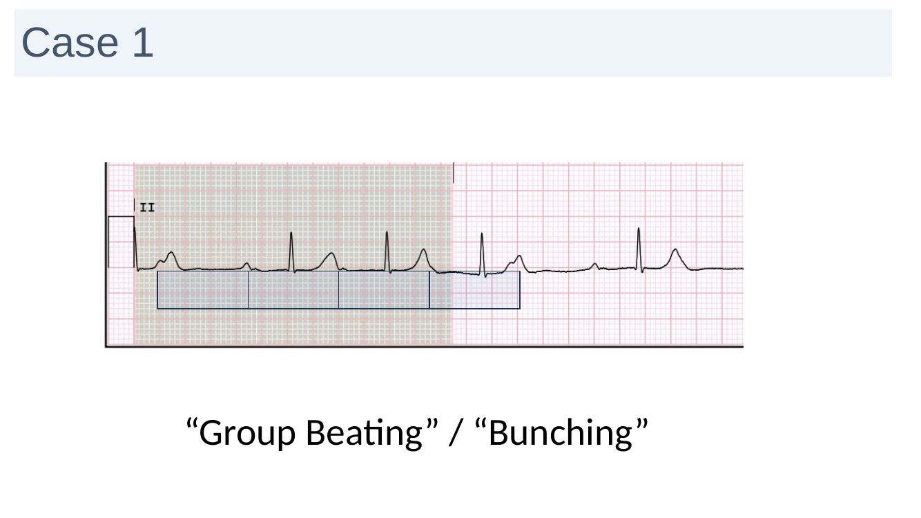 Group beating ECG slide