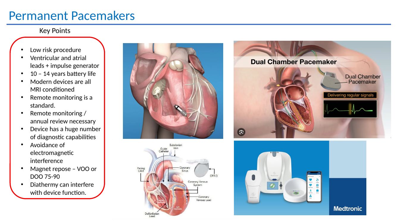 Permanent pacemaker key points