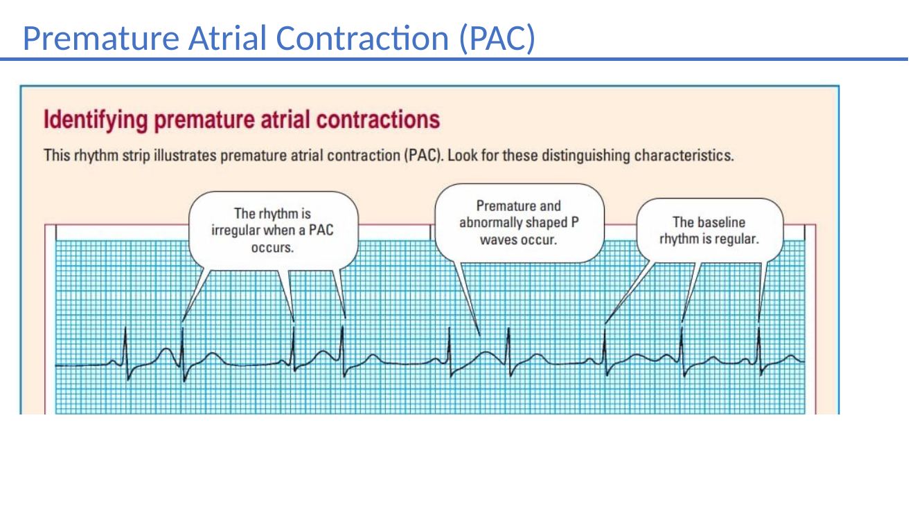 Premature atrial contractions